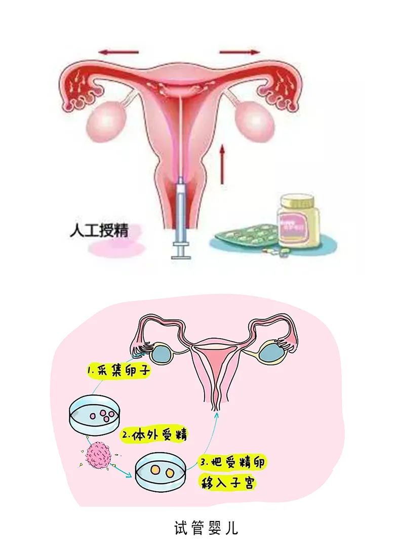女性不孕症